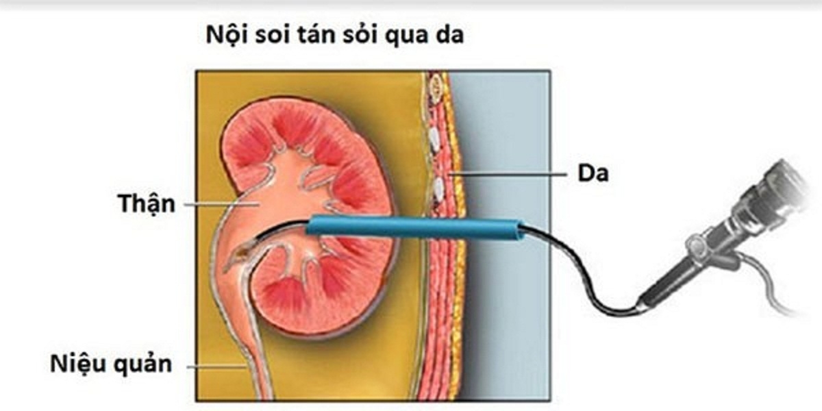 Tán sỏi qua da &#8211; bước tiến mới trong điều trị sỏi tiết niệu