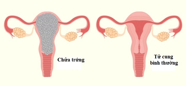 Thai trứng là hiện tượng nang nước xuất hiện trong tử cung phụ nữ