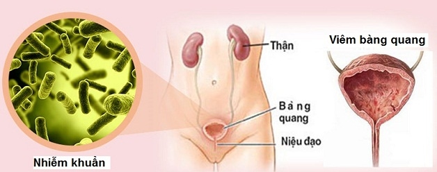 Viêm đường tiết niệu viêm bàng quang chiếm đến 50% các trường hợp viêm nhiễm