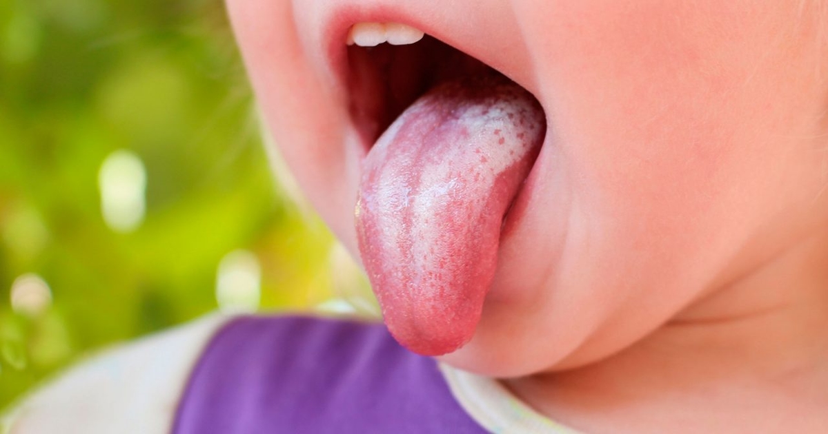 Mách mẹ phương pháp phòng tránh hiệu quả bệnh nấm miệng ở trẻ em