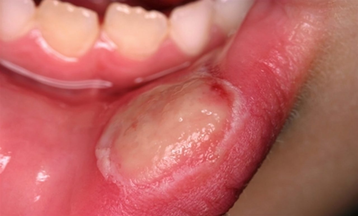 Bệnh viêm niêm mạc miệng có thể điều trị hiệu quả bằng cách nào?