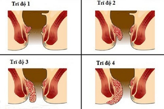 Trĩ nội độ 3 không thể tự khỏi và dễ dàng biến chứng sang cấp độ 4