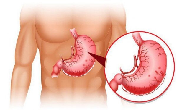 Đau dạ dày đau bên nào là câu hỏi được nhiều người quan tâm
