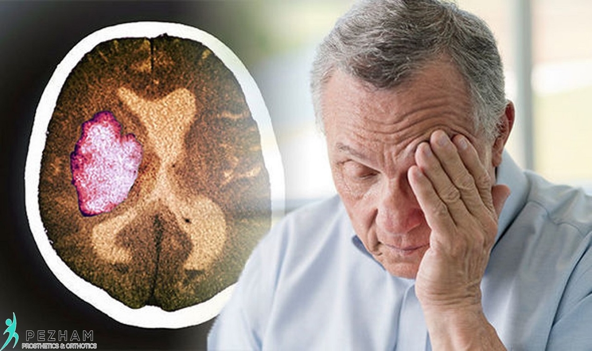 Nguyên nhân gây đột quỵ nhẹ, cách chẩn đoán và điều trị