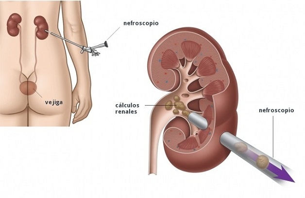 Mổ nội soi sỏi tiết niệu qua da xâm lấn tối thiểu, không lo sót sỏi
