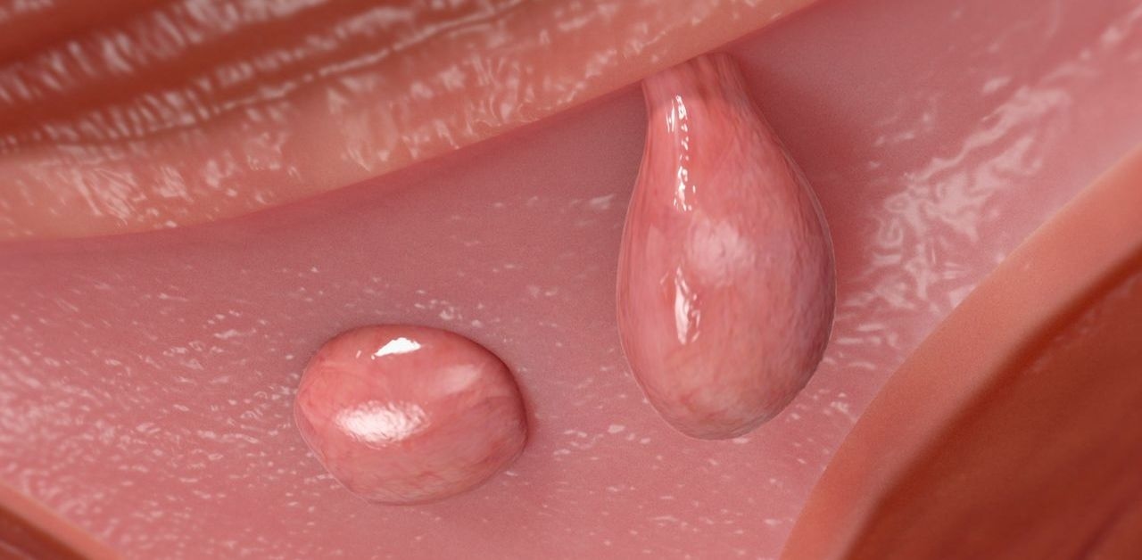 Phẫu thuật cắt polyp tử cung và những điều cần biết
