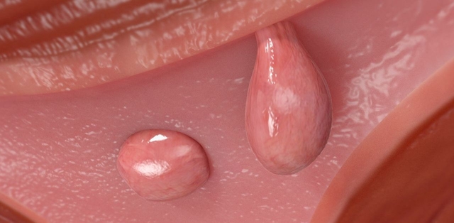 Phẫu thuật cắt polyp tử cung và những điều cần biết