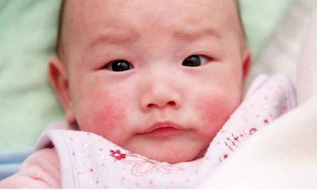 Trẻ bị nổi mẩn đỏ quanh miệng