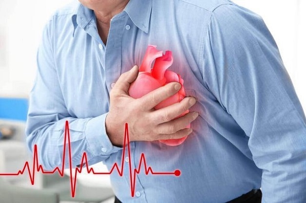 Đau thắt ngực là triệu chứng điển hình của bệnh mạch vành mạn 