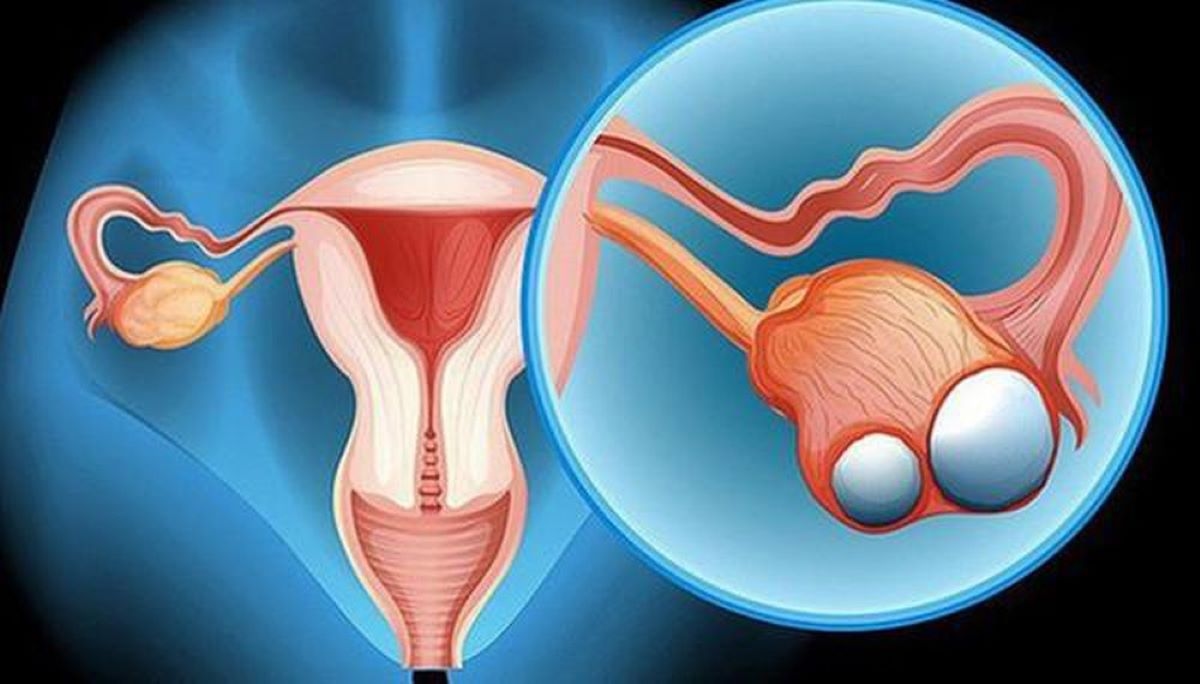 6 điều về u bì buồng trứng chị em nhất định phải biết
