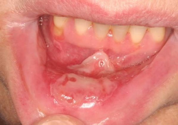 Bệnh viêm niêm mạc miệng