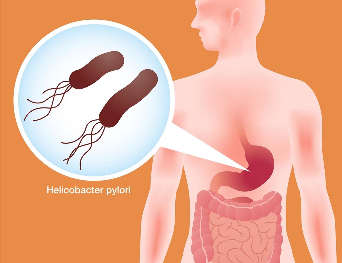 Giải đáp thắc mắc bị vi khuẩn Hp không nên ăn gì?