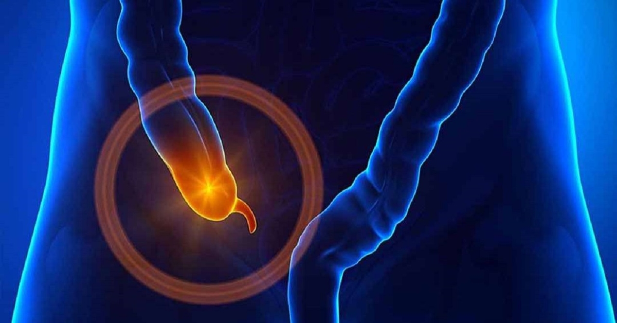 Biểu hiện của viêm ruột thừa cấp và cách điều trị
