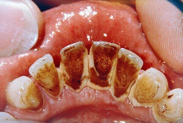 Cao răng bình thường có màu vàng hoặc nâu, bám trên bề mặt răng. Nhưng một số trường hợp, cao răng có màu đen gây nên mất thẩm mỹ và cần được sớm loại bỏ. 