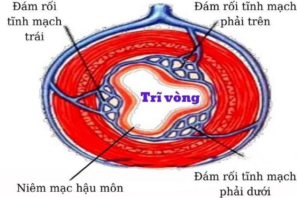 Trĩ vòng là gì? Tìm hiểu phương pháp cắt trĩ vòng hiệu quả