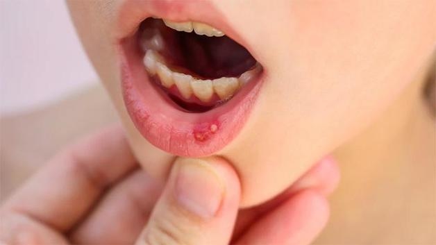 nhiệt miệng là gì