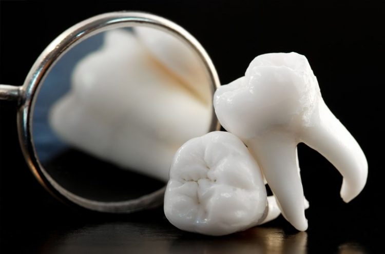 Có nên nhổ răng khôn không là câu hỏi nhiều người băn khoăn