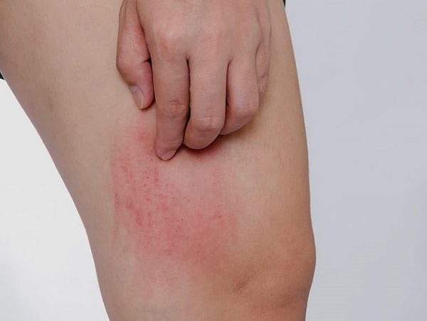 Ngứa da là một triệu chứng của viêm gan D