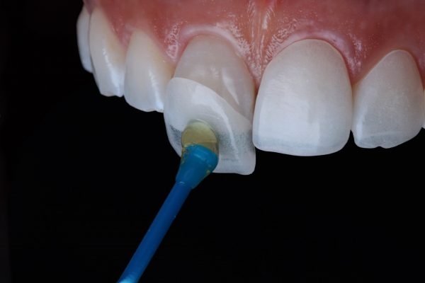 Dán veneer răng (dán răng sứ veneer) là phương pháp sử dụng mặt dán bằng sứ siêu mỏng khoảng 0.2 - 0.5mm được nhập khẩu từ nước ngoài để dán cố định lên bề mặt của răng.