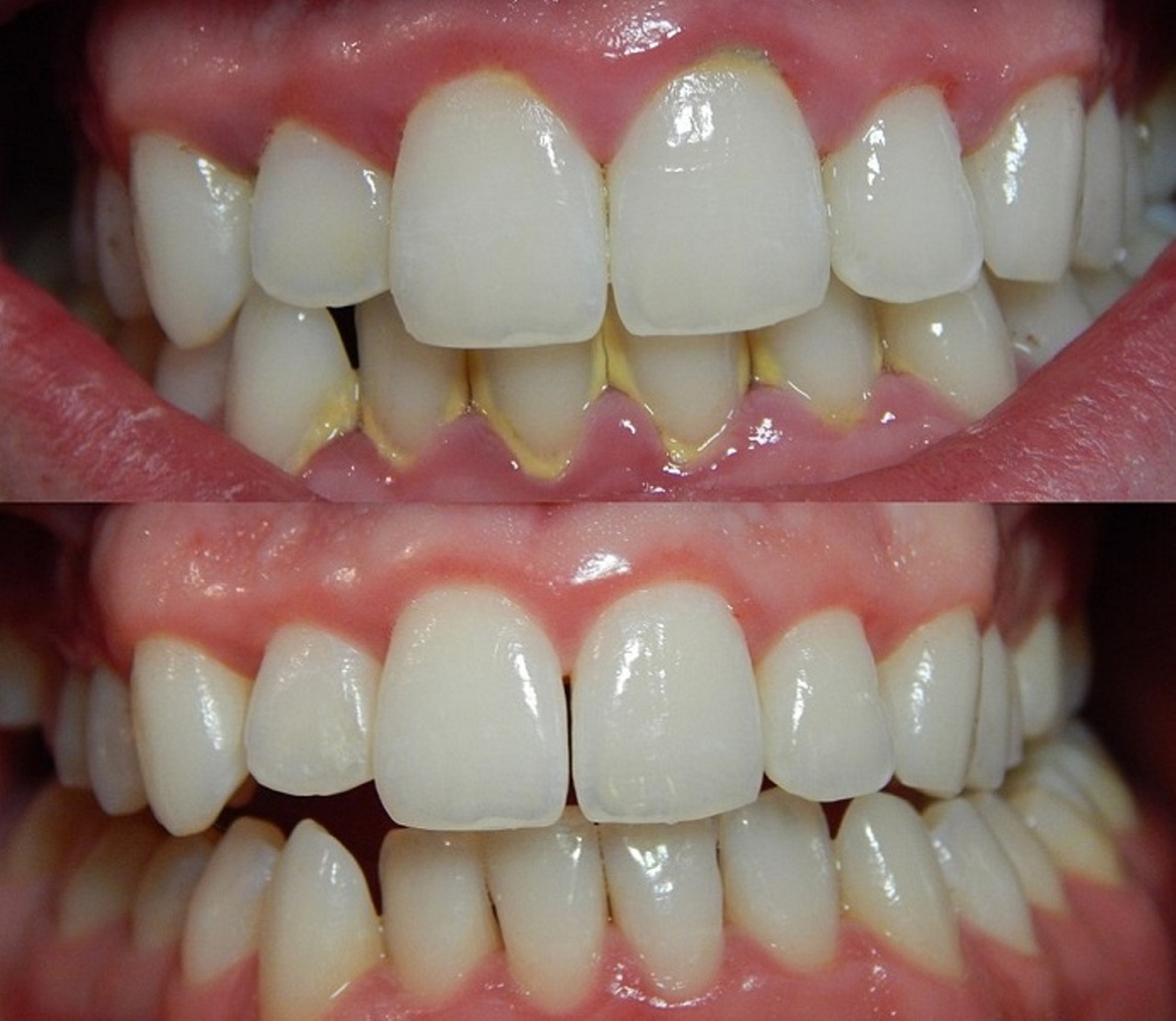5 dấu hiệu viêm nha chu &#8211; Chớ coi thường kẻo mất răng