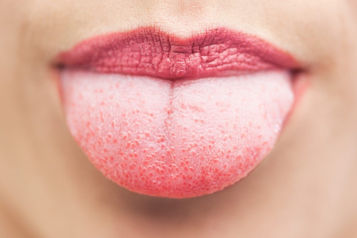Nấm miệng Candida ở người lớn