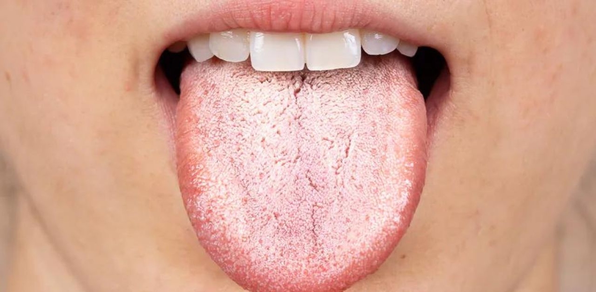 Nấm miệng Candida là bệnh gì?