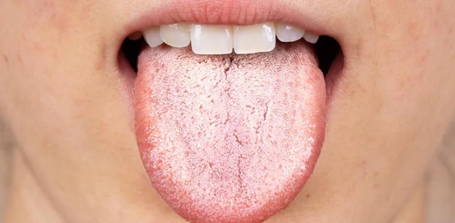 Nấm miệng Candida là bệnh gì?