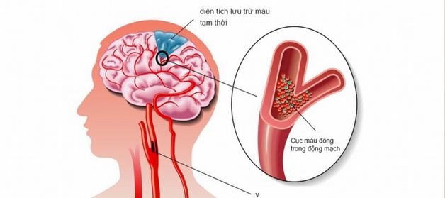 thiếu máu não là gì