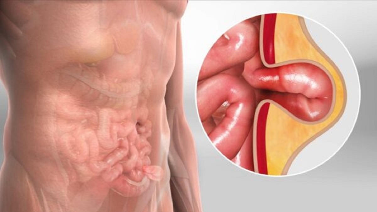 Thoát vị bẹn nghẹt &#8211; trường hợp cấp cứu ngoại khoa nguy hiểm