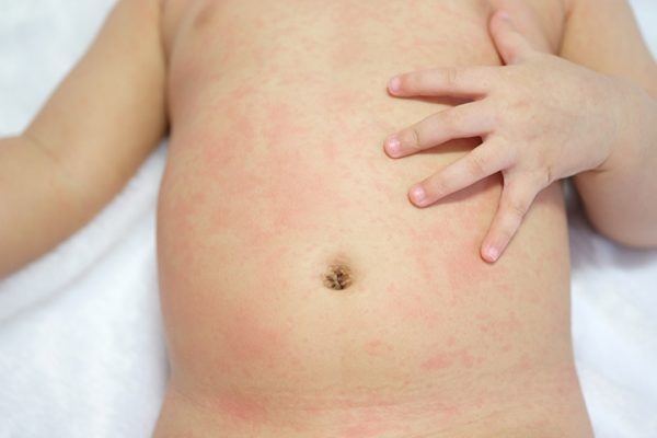 Nguyên nhân gây phát ban sau khi hết sốt