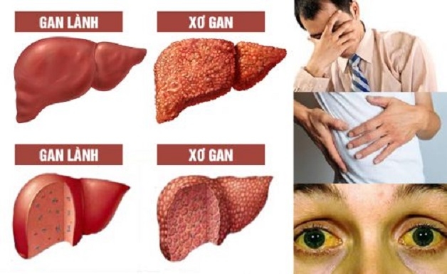 Xơ gan và những triệu chứng kèm theo có thể nhận biết xơ gan độ 4 qua các triệu chứng như vàng da, cổ trướng,xuất huyết tiêu hóa...