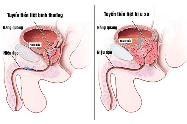 U xơ tuyến tiền liệt là cái gì?
