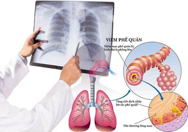 Viêm phế quản ở trẻ nhỏ là hiện tượng đường thở dưới bị vi khuẩn tấn công gây viêm nhiễm.