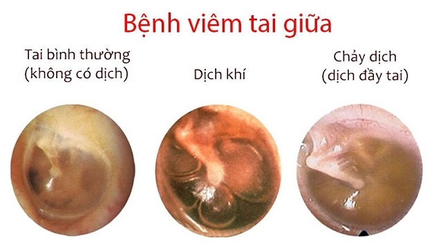 Viêm tai giữa trẻ sơ sinh là hiện tượng tai bị vi khuẩn, virus tấn công gây nhiễm trùng, xuất hiện nhiều dịch ở tai