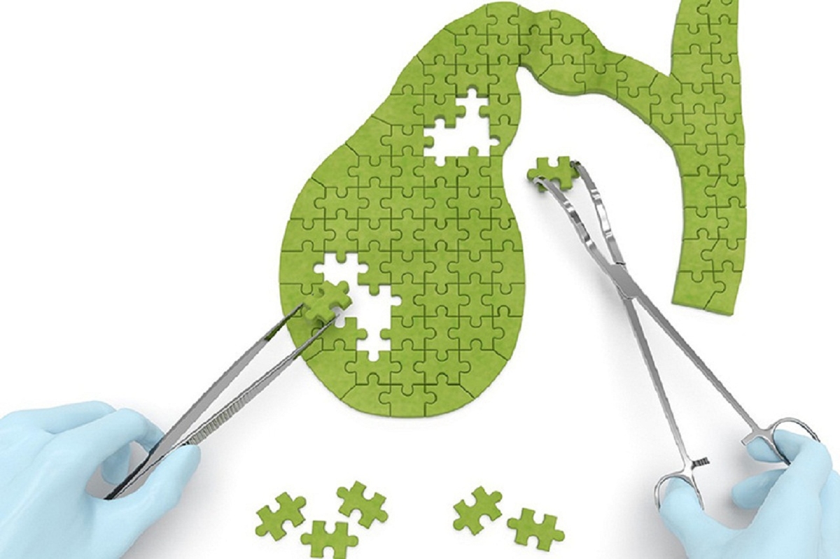 Viêm túi mật hoại tử &#8211; biến chứng nguy hiểm cần xử lý gấp