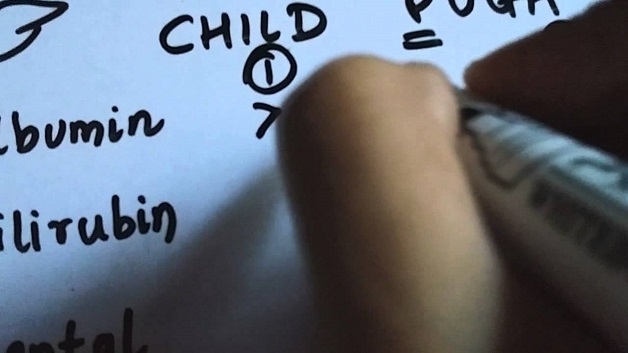 rối loạn chức năng gan xơ gan Child Pugh