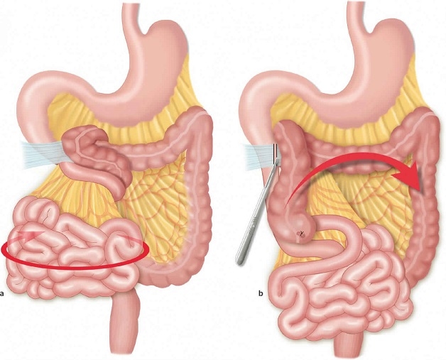 Khi đó, tạng thoát vị thường là quai ruột non xãy ra đột ngột, thường làm xoắn thành phần trong túi thoát vị, trong đó có cả động mạch và tĩnh mạch của đoạn ruột