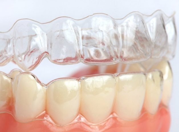 Niềng răng không mắc cài 3D Clear
