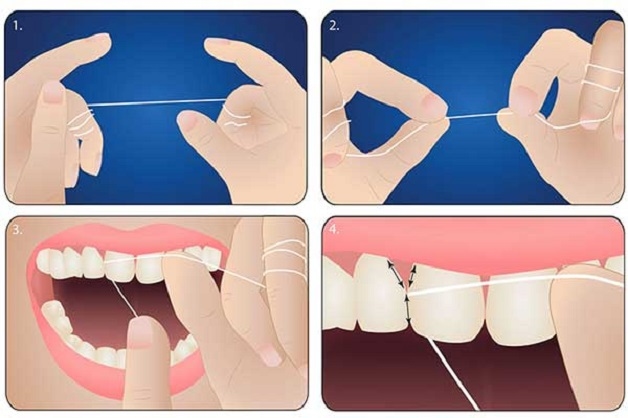 Người bệnh nên sử dụng chỉ nha khoa để loại bỏ cặn thức ăn, cải thiện tình trạng răng miệng