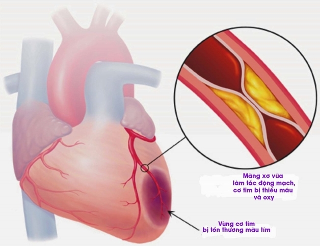 bị hở van tim 3 lá 1/4 có nguy hiểm không 