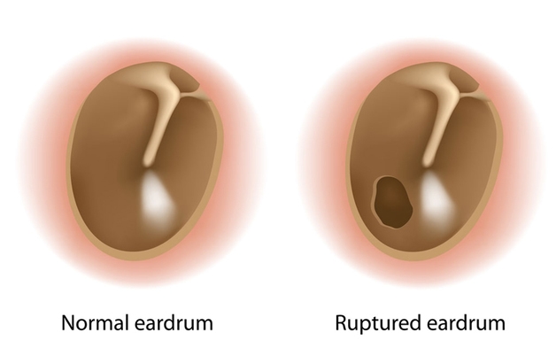 cách phẫu thuật vá màng nhĩ