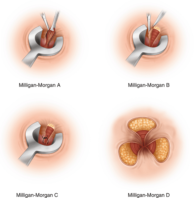 Phương pháp cắt trĩ milligan morgan