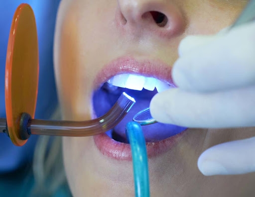 Chiếu đèn quang trùng hợp với từng lớp Composite, thời gian khoảng 20 - 40 giây.