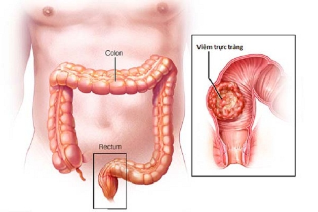 Viêm đại trực tràng là bệnh lý phổ biến nhất trong các bệnh liên quan đến đại trực tràng