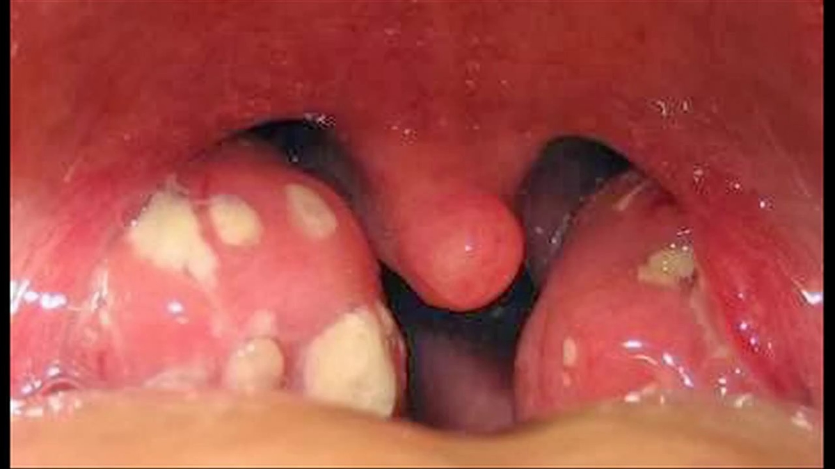 Đừng coi thường viêm amidan cấp mủ