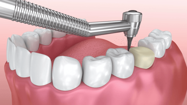 Để có thể gắn được mão răng lên, bác sĩ sẽ tiến hành mài cùi răng thật của bệnh nhân