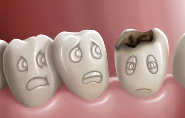 Sâu răng được coi là một trong những nguyên nhân hàng đầu khiến trẻ bị những cơn đau răng “hành hạ”.