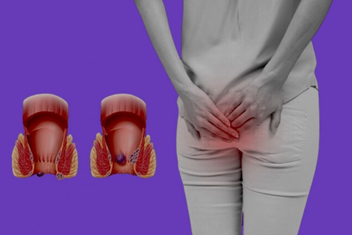 Nguyên nhân rò hậu môn là gì? Triệu chứng và cách điều trị