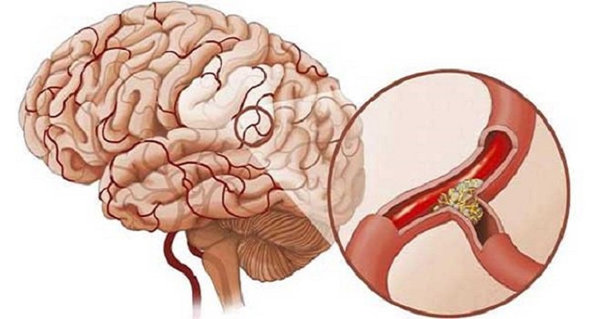 Đột quỵ nhồi máu não: Những điều không thể bỏ qua!
