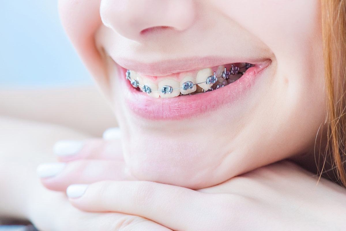 Trẻ nềng răng mắc cài